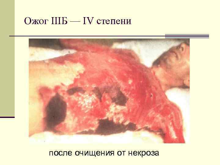 Ожог IIIБ — IV степени после очищения от некроза 