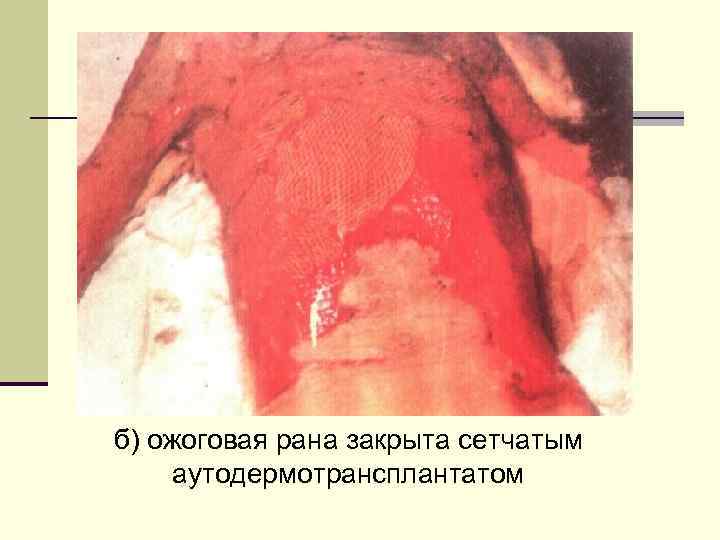 б) ожоговая рана закрыта сетчатым аутодермотрансплантатом 