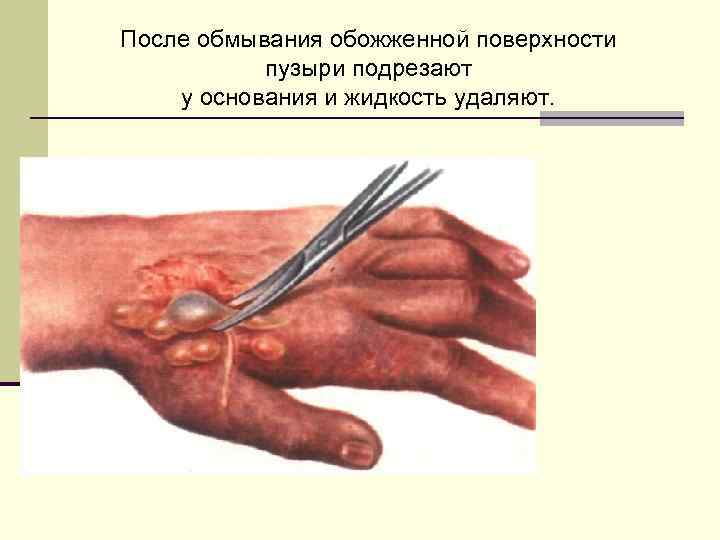 После обмывания обожженной поверхности пузыри подрезают у основания и жидкость удаляют. 