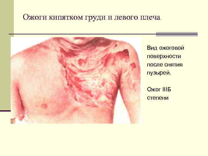 Ожоги кипятком груди и левого плеча Вид ожоговой поверхности после снятия пузырей. Ожог IIIБ