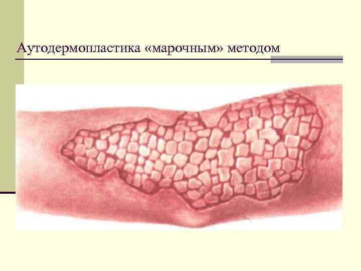 Аутодермопластика «марочным» методом 