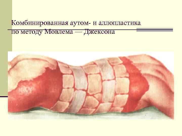 Комбинированная аутом и аллопластика по методу Мовлема — Джексона 