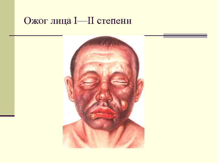 Ожог лица I—II степени 