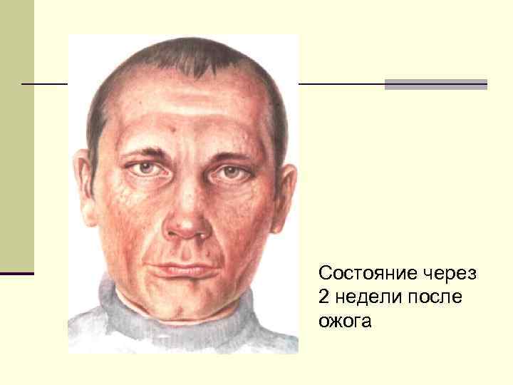 Состояние через 2 недели после ожога 