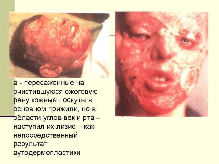 а - пересаженные на очистившуюся ожоговую рану кожные лоскуты в основном прижили, но в