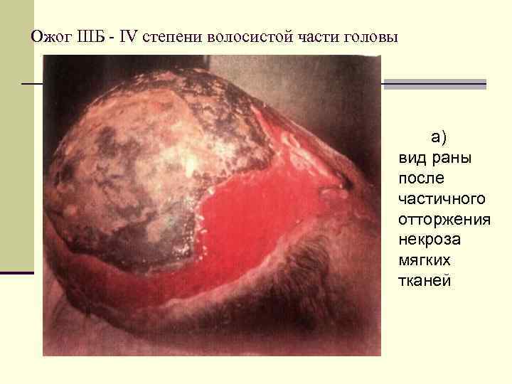 Ожог IIIБ IV степени волосистой части головы а) вид раны после частичного отторжения некроза