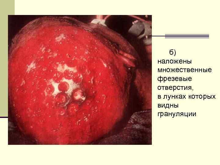б) наложены множественные фрезевые отверстия, в лунках которых видны грануляции 