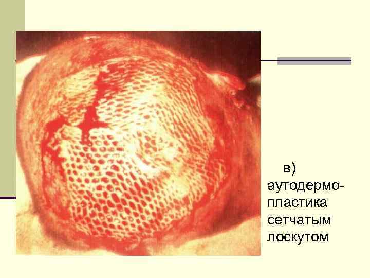 в) аутодермопластика сетчатым лоскутом 