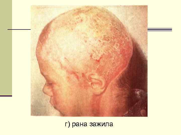 г) рана зажила 