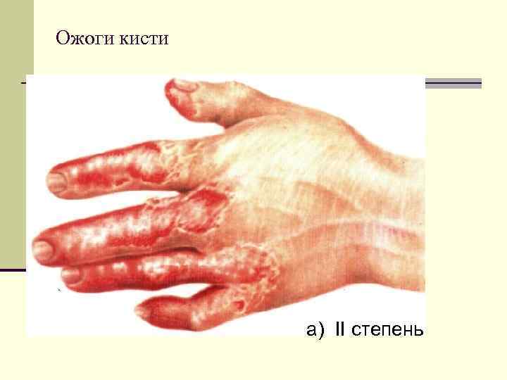 Ожоги кисти а) II степень 