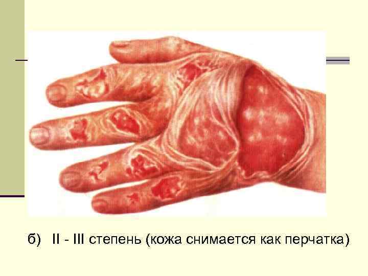 б) II - III степень (кожа снимается как перчатка) 