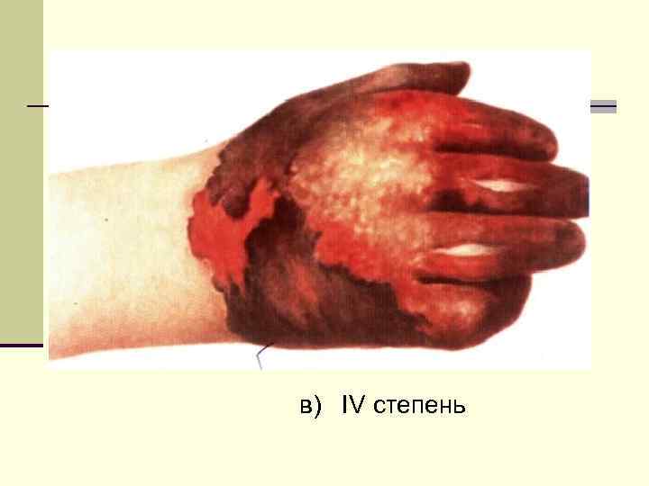 в) IV степень 