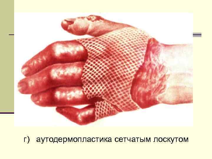 г) аутодермопластика сетчатым лоскутом 
