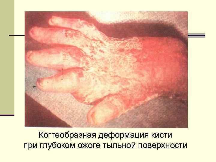 Когтеобразная деформация кисти при глубоком ожоге тыльной поверхности 