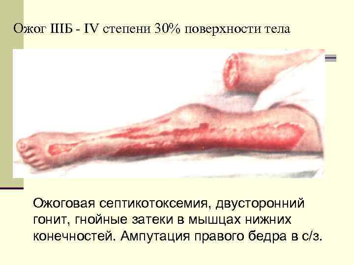 Ожог IIIБ IV степени 30% поверхности тела Ожоговая септикотоксемия, двусторонний гонит, гнойные затеки в