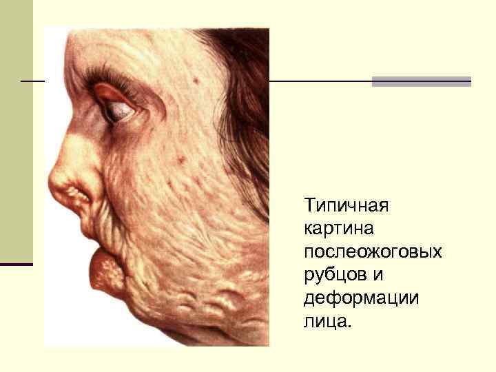 Типичная картина послеожоговых рубцов и деформации лица. 