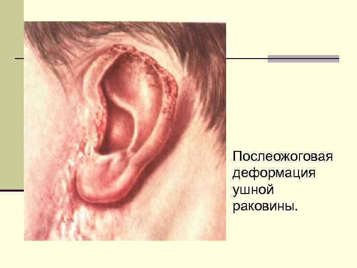 Послеожоговая деформация ушной раковины. 