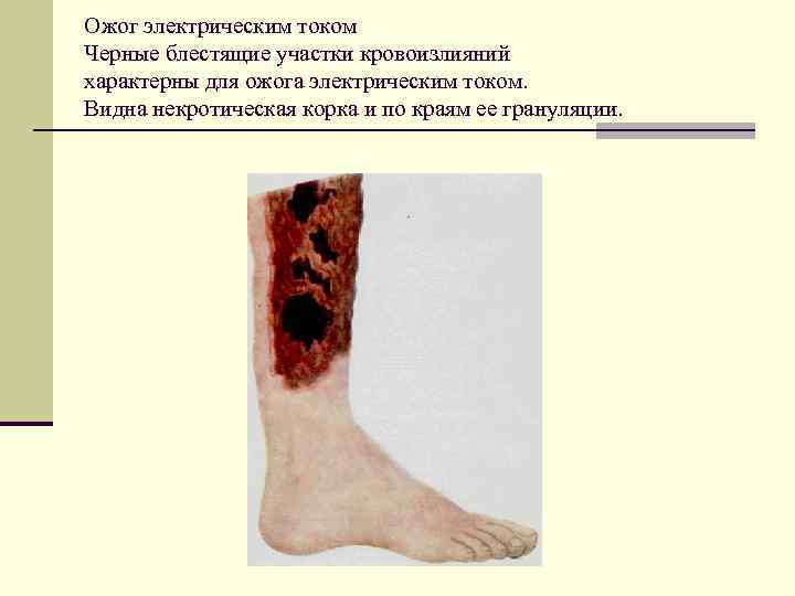 Ожог электрическим током Черные блестящие участки кровоизлияний характерны для ожога электрическим током. Видна некротическая