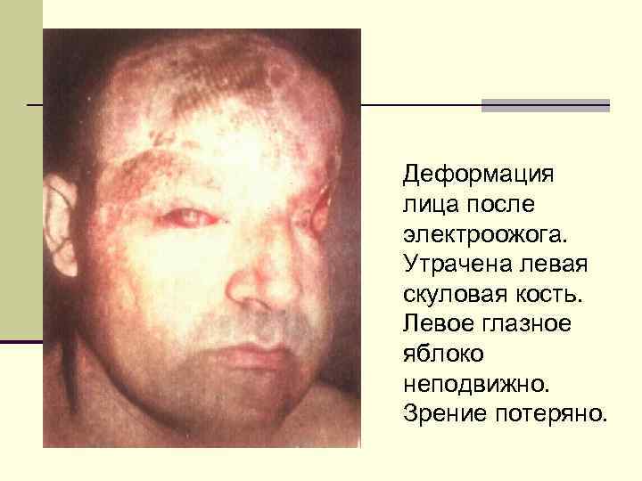 Деформация лица после электроожога. Утрачена левая скуловая кость. Левое глазное яблоко неподвижно. Зрение потеряно.