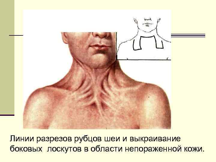 Линии разрезов рубцов шеи и выкраивание боковых лоскутов в области непораженной кожи. 