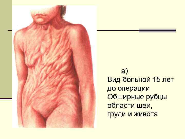 а) Вид больной 15 лет до операции Обширные рубцы области шеи, груди и живота