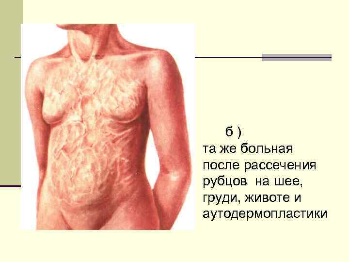 б) та же больная после рассечения рубцов на шее, груди, животе и аутодермопластики 