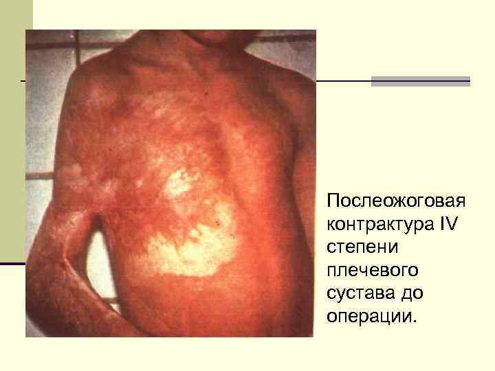 Послеожоговая контрактура IV степени плечевого сустава до операции. 
