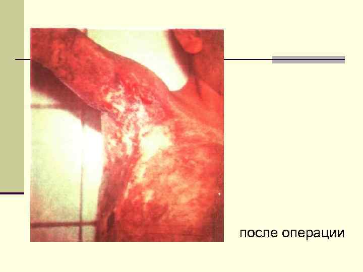 после операции 