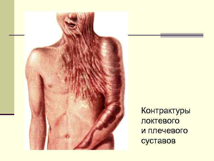Контрактуры локтевого и плечевого суставов 