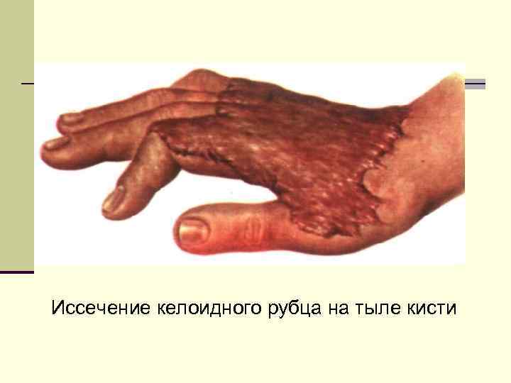 Иссечение келоидного рубца на тыле кисти 