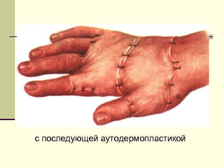 с последующей аутодермопластикой 