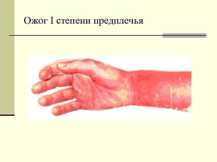 Ожог I степени предплечья 