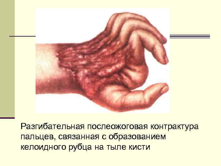 Разгибательная послеожоговая контрактура пальцев, связанная с образованием келоидного рубца на тыле кисти 