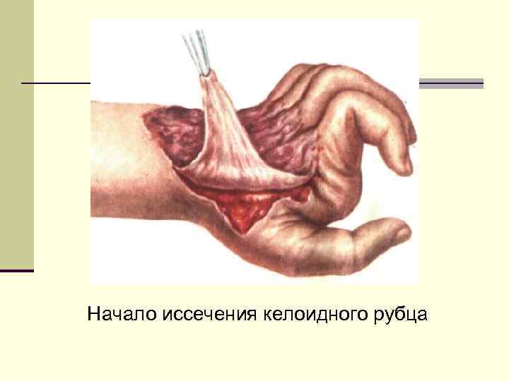 Начало иссечения келоидного рубца 
