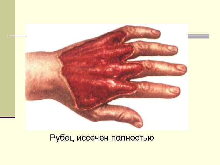 Рубец иссечен полностью 