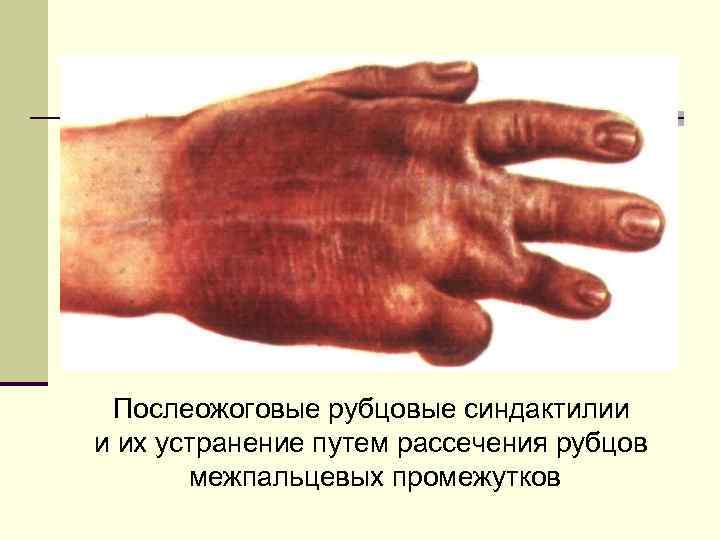 Послеожоговые рубцовые синдактилии и их устранение путем рассечения рубцов межпальцевых промежутков 