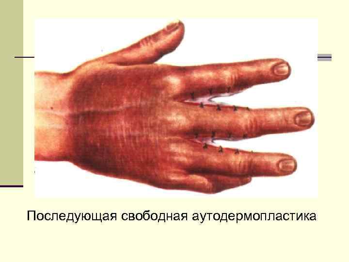 Последующая свободная аутодермопластика 