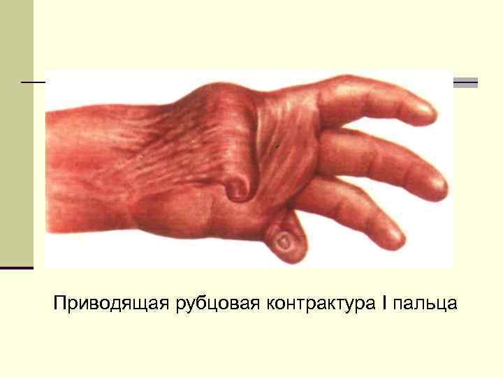 Приводящая рубцовая контрактура I пальца 