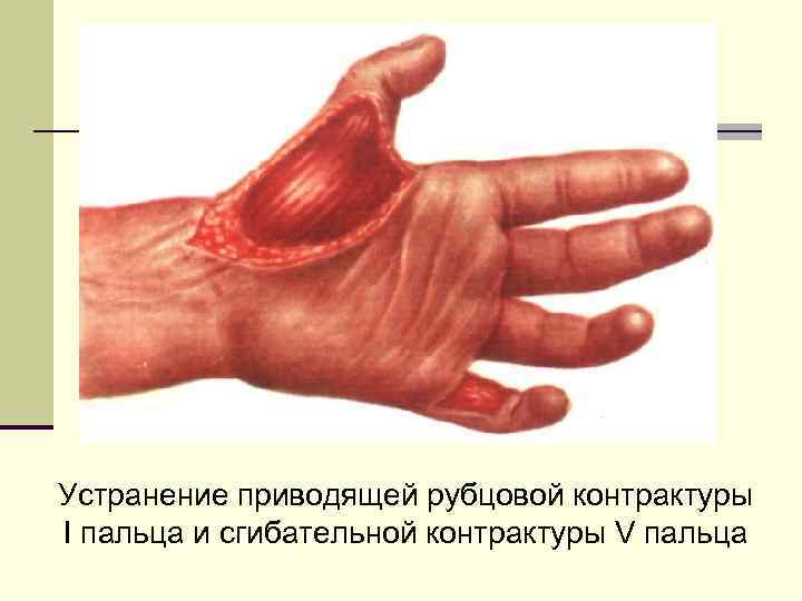 Устранение приводящей рубцовой контрактуры I пальца и сгибательной контрактуры V пальца 