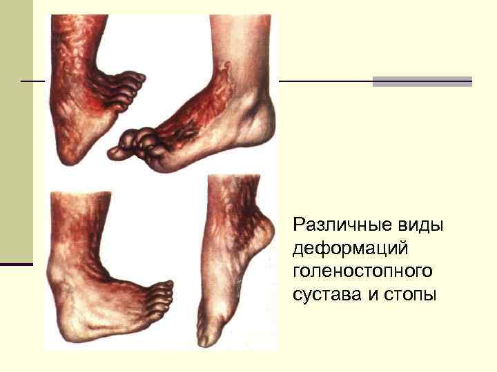 Различные виды деформаций голеностопного сустава и стопы 