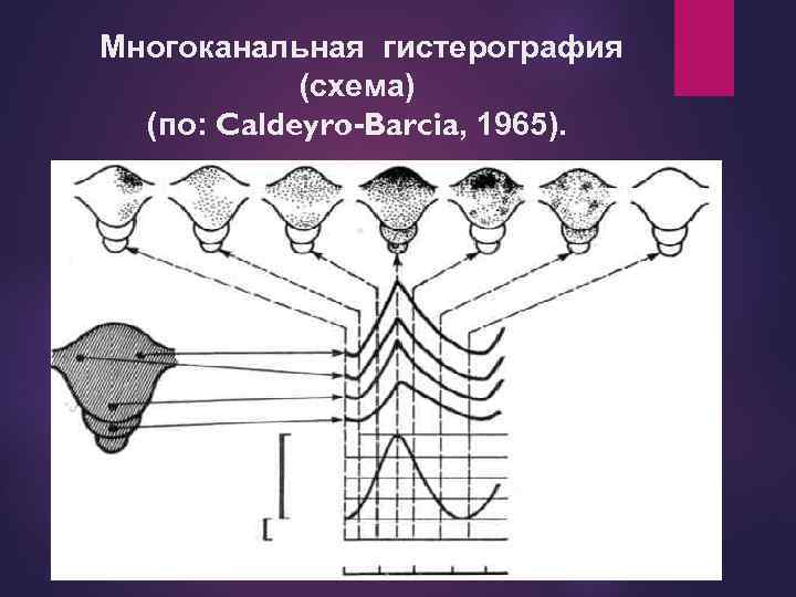 Многоканальная гистерография (схема) (по: Caldeyro-Barcia, 1965). 