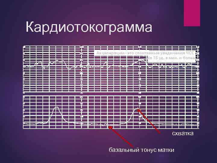 Кардиотокограмма схватка базальный тонус матки 