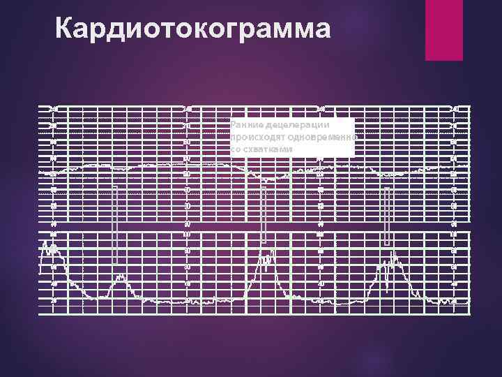 Кардиотокограмма 