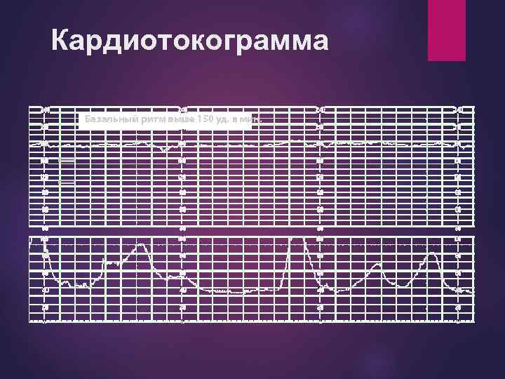 Кардиотокограмма 