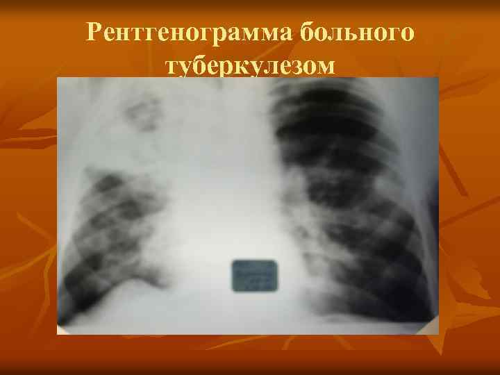 Рентгенограмма больного туберкулезом 