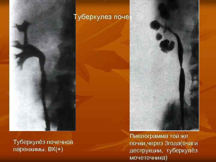 Туберкулез почек Туберкулёз почечной паренхимы. ВК(+) Пиелограмма той же почки, через 3 года(очаги деструкции,