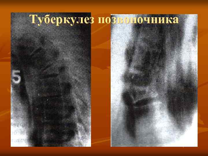 Туберкулез позвоночника 