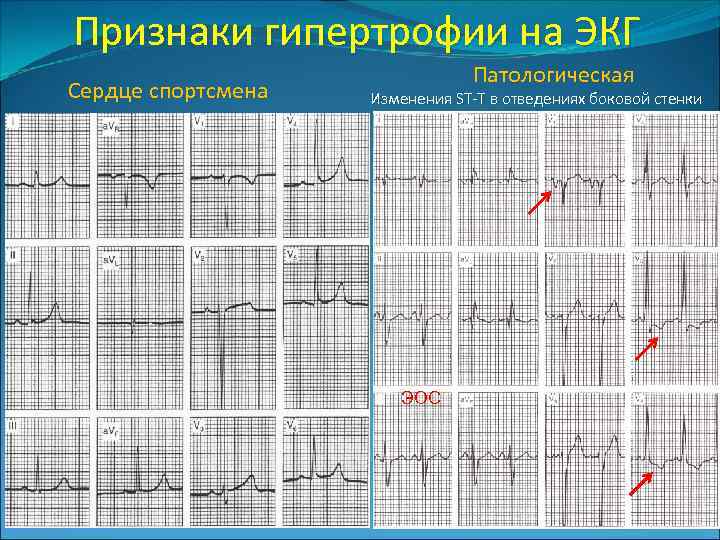 Признаки гипертрофии на ЭКГ Сердце спортсмена Патологическая Изменения ST-T в отведениях боковой стенки ЭОС