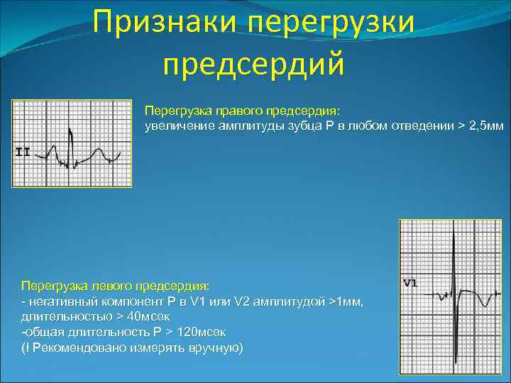 Признаки перегрузки предсердий Перегрузка правого предсердия: увеличение амплитуды зубца Р в любом отведении >