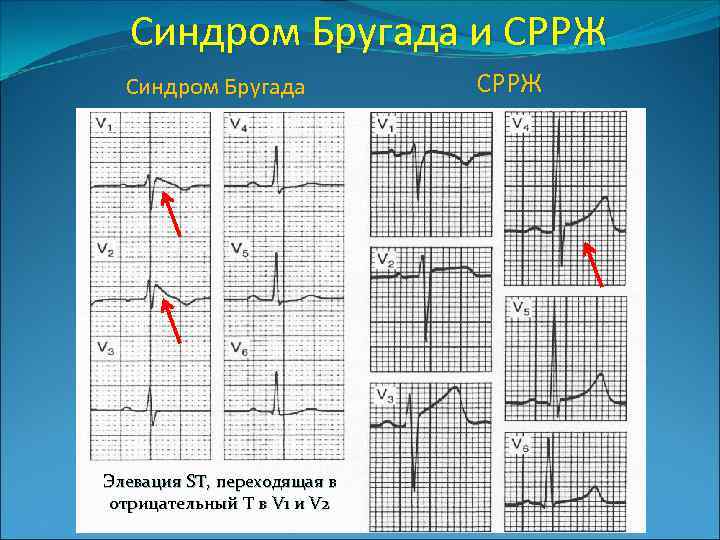 Синдром Бругада и СРРЖ Синдром Бругада Элевация ST, переходящая в отрицательный Т в V